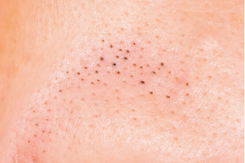 Blackheads and whiteheads acne