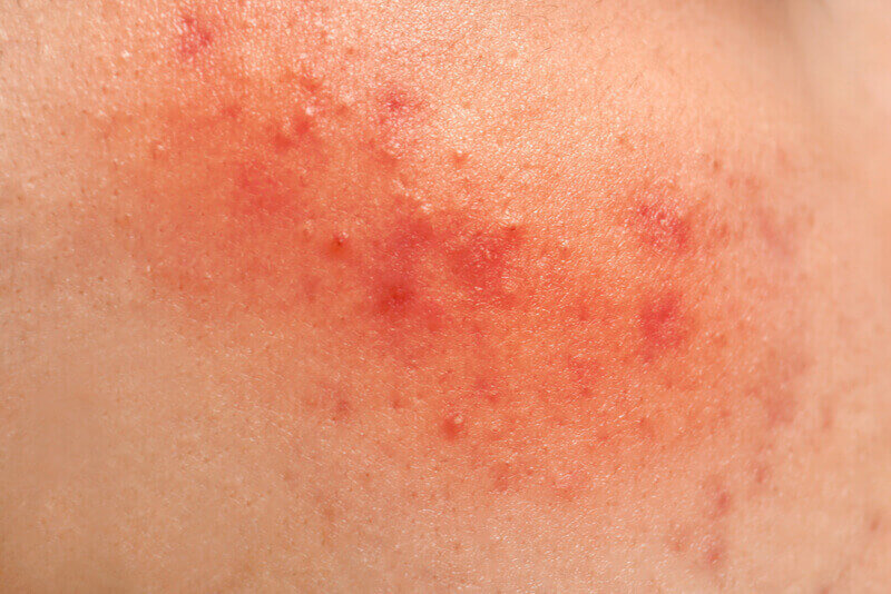 skin irritation symptoms reaction to benzoyl peroxide
