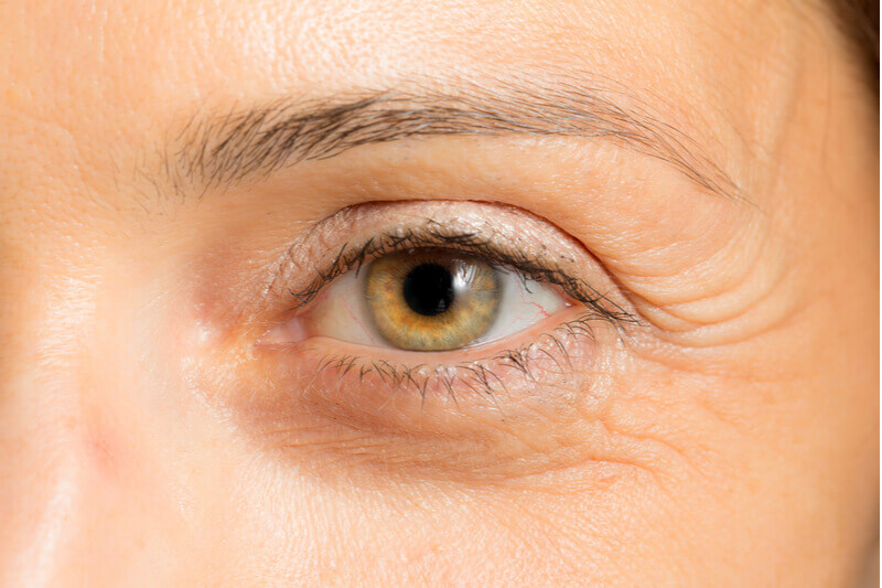wrinkles and lines under eyes